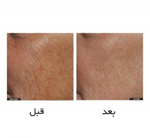 قیمت دستگاه پلاژن