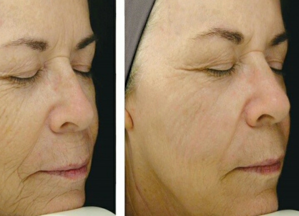 قیمت روز لیزر جوانسازی در تهران