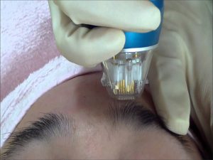 خرید دستگاه آر اف فرکشنال